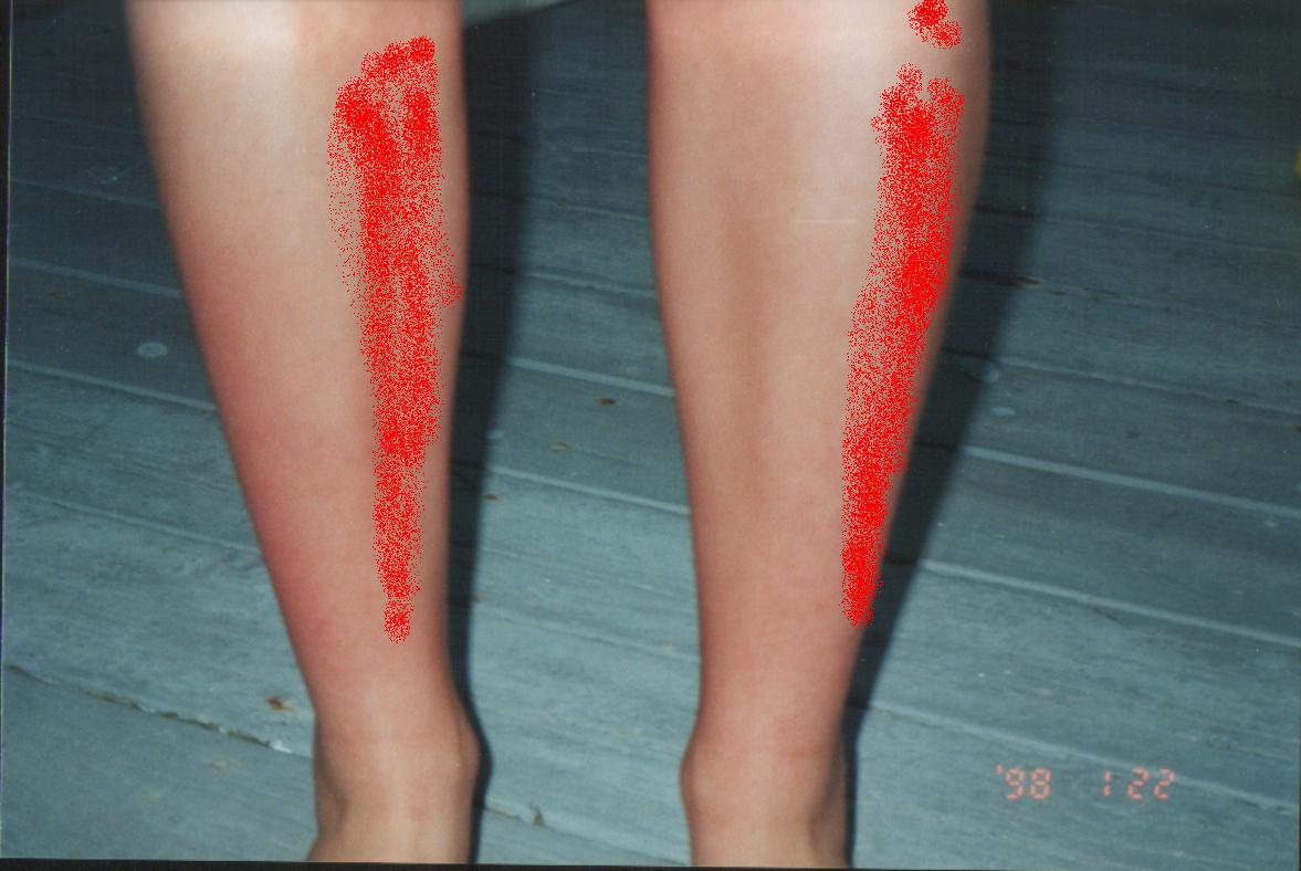 sbsunburn.jpg